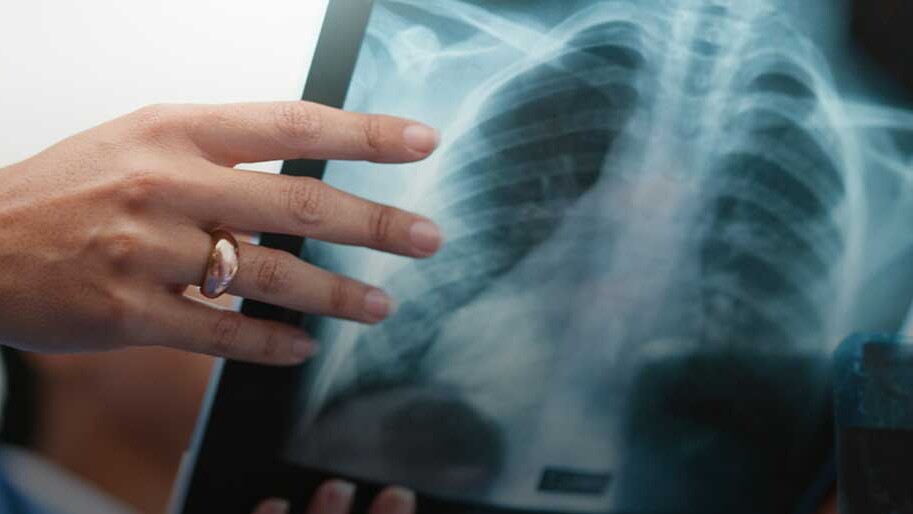 Practice Area: Mesothelioma cases